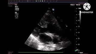 D transposition of Great Arteries with Severe PS [upl. by Tj713]