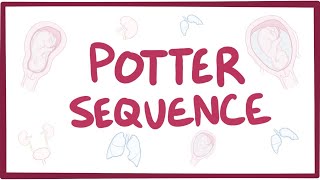 Potter sequence oligohydramnios  causes symptoms diagnosis treatment pathology [upl. by Azpurua]