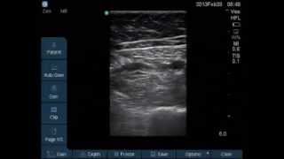 Saphenous Nerve block at adductor canal for Knee Arthroscopy [upl. by Patrizius]