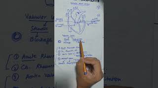 Valvular heart disease pathology pathoma robbins mbbs cvs cardiac [upl. by Assedo]