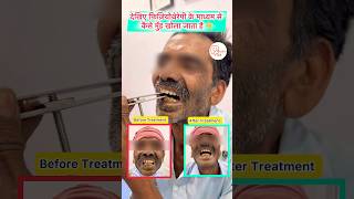 Mouth Opening Exercises for Cancer Patients  Cancer Trismus care shorts mouthcancertreatment [upl. by Castra]