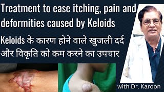 Treatment to ease itching pain and deformities caused by Keloids in Hindi  Dr Karoon Agrawal [upl. by Branham]