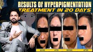 Results of Hyperpigmentation Treatment in 20 Days  DrLalit Kasanas [upl. by Indyc757]