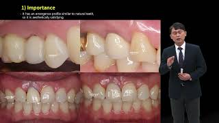 PROSTHODONTICS Design of Esthetic implant Prosthesis [upl. by Goldwin]