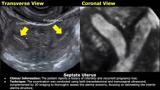 Congenital Uterine Anomalies Ultrasound Reporting  Didelphys Bicornuate Unicornuate Uterus USG [upl. by Jahdal]