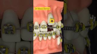 Yellow Colour Braces  Tooth Vlog Orthotics [upl. by Eirlav]