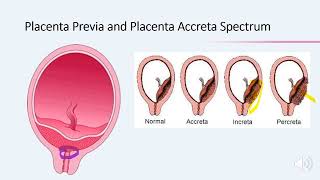 Termination of pregnancy in patients with placenta previa and placenta accreta spectrum  Webinar [upl. by Charita]