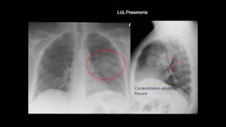 Chest Xray Cases 1 [upl. by Tien]