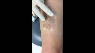 Laser Birthmark Removal [upl. by Aynotel]