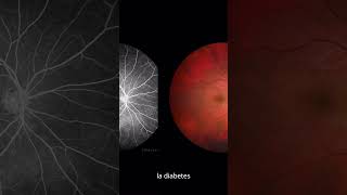 ¿Qué causa la retinopatía diabética salud diabetesmellitustipo2 prevencióndeenfermedades [upl. by Ordnagela]