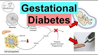 Gestational Diabetes Pregnancy Diabetes  Causes Risk Factors Symptoms Consequences Treatment [upl. by Ekram919]