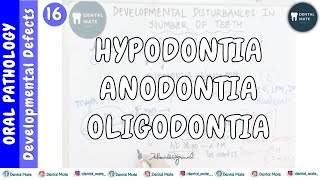 Hypodontia  Anodontia  Oligodontia  Developmental disturbances of teeth  Dr Paridhi Agrawal [upl. by Pickford]