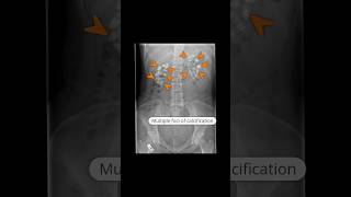 Medullary nephrocalcinosis due to type 1 renal tubular acidosis virlshorts [upl. by Nura637]