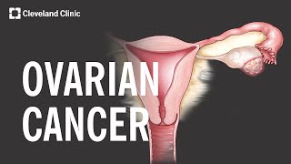 5 Warning Signs and Risk Factors of Ovarian Cancer [upl. by Repinuj]