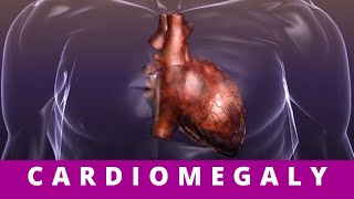 CARDIOMEGALY what causes cardiomegaly [upl. by Ttocserp569]