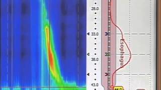 esophageal manometry [upl. by Aihpos]