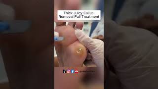 Ultimate Callus Removal Full Treatment For Smooth Feet  FootClinicLondoncouk [upl. by Smail541]