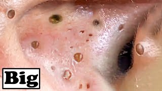 Super Removal Blackheads In Ear [upl. by Katherin]