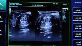 Intussusception Ultrasound [upl. by Cedell]