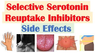 SSRI Antidepressant Side Effects amp Why They Occur  Fluoxetine Paroxetine Sertraline Citalopram [upl. by O'Grady219]