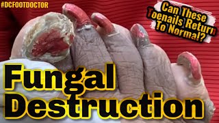 Fungal Destruction Can These Toenails Return To Normal [upl. by Googins]