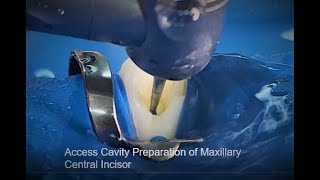 Access Cavity Preparation of Maxillary Central Incisor [upl. by Padraig]