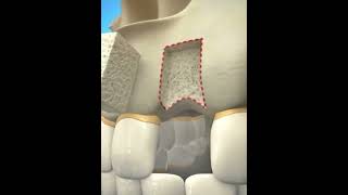 How new teeth is transplanted  animationshorts shortsfeed youtubeshorts viralshorts [upl. by Anazus]