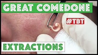 Greatest Blackheads and Whiteheads TBT [upl. by Ojytteb680]