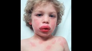 Anaphylaxis and Acute Allergic reaction  How to Help [upl. by Gagne307]