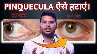 How To Remove Pinquecula सबसे आसान उपाय Lokesh Dixit [upl. by Nimra227]