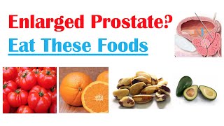 Best Foods to Eat with Enlarged Prostate  Reduce Risk of Symptoms Enlargement amp Cancer [upl. by Aerdnahs177]