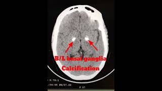 BL Basal Ganglia Calcification BRAIN CT shortvideo [upl. by Suiluj788]