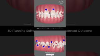 Correction of Gaps in Teeth with Invisalign Braces  Invisalign Kolkata invisalign clearaligner [upl. by Conley]