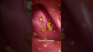 What Are Tonsil Stones 🤔 [upl. by Arraeic]