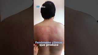 Dermografismo marcas en la piel al rascarse  Skin hospital  urticaria [upl. by Ram]