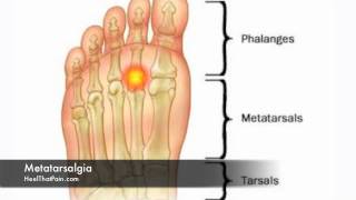 Metatarsalgia Foot Pain Causes Symptoms amp Treatments [upl. by Adnohsirk259]