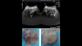 SHADOWING IN THE ADNEXA DIFFERENTIAL DIAGNOSES [upl. by Johns]