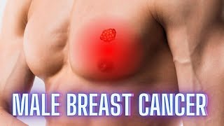 Male Breast Cancer What You Need to Know [upl. by Kathe]