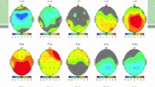 Becky Bingham Brain maps Part 2 The QEEG report [upl. by Eiclek]