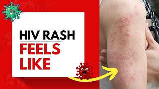 HIV Rash Feels Like [upl. by Trebmer927]