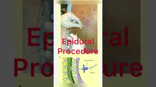 Epidural Catheter  Epidural Anesthesia Removal  Lumber Epidural Removal  Dr Raj doctor shorts [upl. by Iblehs192]