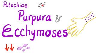 Petechiae Purpura and Ecchymoses [upl. by Haya]