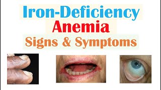 IronDeficiency Anemia Signs amp Symptoms ex Fatigue “Spoon Nails” Cracked Lips [upl. by Devaney]