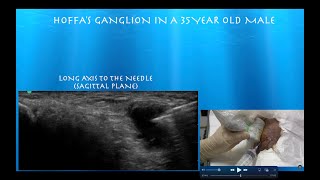 Ultrasound Guided Aspiration and Injection of a Hoffas Fat Pad Ganglion [upl. by Hubble125]