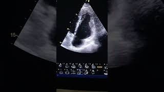 Right ventricular arrhythmogenic cardiomyopathy [upl. by Ripp]