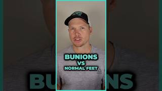 Bunions vs Normal Feet Can Foot Exercises Correct Bunions [upl. by Lebasiram]