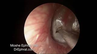 ENDOCSOPIC MUCOID OTITIS MEDIA DRAINAGE [upl. by Nylassej]