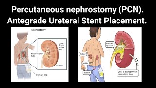 cathlab nursing kidneydisease nephrology DJstenting  Antegrade Ureteral Stent Placement [upl. by Leinahtan]