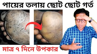 এই রোগ কিভাবে সারাবেন  Pitted keratolysis  Treatment  Bengali [upl. by Jo]