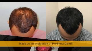 Best laser hair growth device  Laser Treatments for Thinning Hair [upl. by Helge]